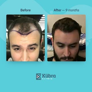 We’re now taking bookings for FUE #hairtransplant at a competitive all-inclusive price 👌🏻