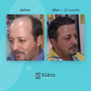 Frozen Sapphire FUE #hairtransplant package to cover all your trip expenses and aftercare products.