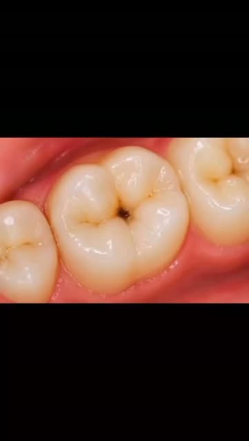 #delaytodaypaymoretomorrow #mokshithclinics #dentalcare #ᴠɪʀᴀʟᴘᴏsᴛ #earlydiagnosismatters 

🦷 Don’t