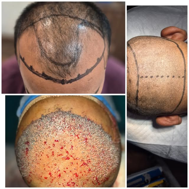 #hairtransplantationsurgery #precision
#mokshithclinics#keepevolving💫
#viralrpost 

From planning t