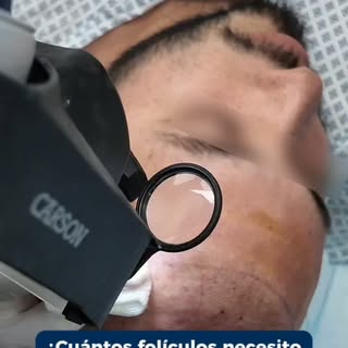 La pérdida de cabello puede afectar mucho más que tu imagen. 🤔
Por eso, cada tratamiento comienza 