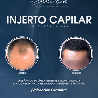 Resultados 100% naturales diseñados a tu medida. 👨‍⚕️✨ Diseñamos tu línea frontal evaluando la edad