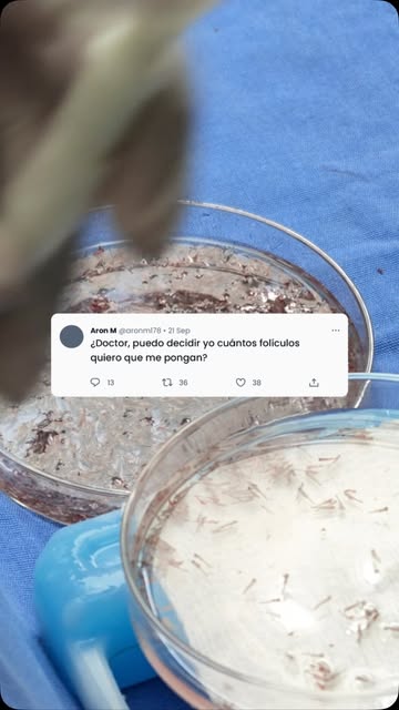 Todo lo que necesitas saber sobre el injerto capilar, directo con el Dr. Emmerson. Escribe tu duda e