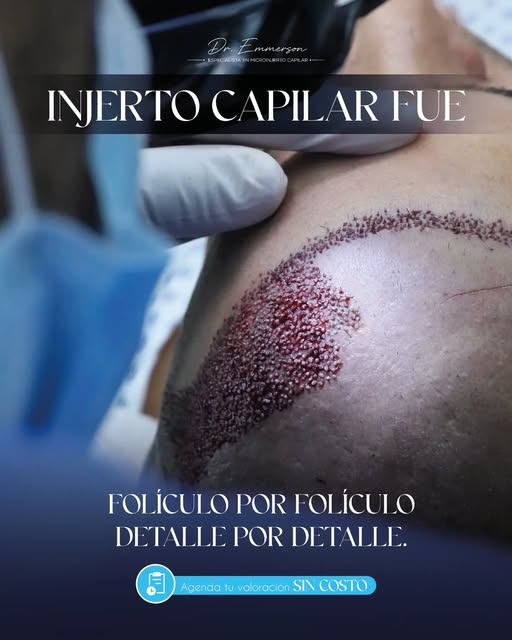 FOLÍCULO POR FOLÍCULO. DETALLE POR DETALLE. 🔬✨
La técnica FUE permite realizar la extracción de un