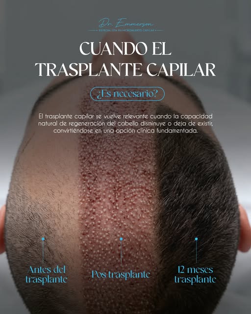 capilar realmente puede ser necesario? 👀
Cuando la pérdida de cabello ha avanzado y la capacidad n