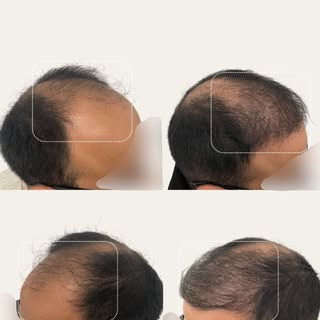 😍Look at this incredible before & after 😍

When it comes to hair transplants, the procedure is onl
