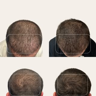 Stronger, thicker, healthier hair — powered by your own body. 

This incredible before & after shows