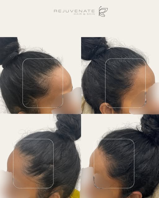 Thinning Hair Doesn’t Have to Be Permanent 💇🏻‍♀️ Female Pattern Hair Loss (FPHL) is a common condi