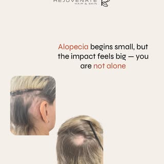 Struggling with Sudden Hair Loss? It Could Be Alopecia Areata 💇🏻‍♀️💔 At Rejuvenate Hair and Skin,