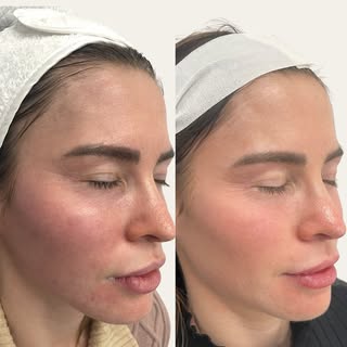 ✨ Skin Goals Unlocked! ✨ Just 3 PRF treatments at Rejuvenate Hair & Skin and the transformation spea