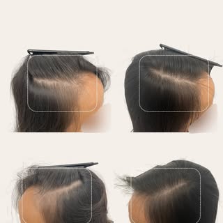 At Rejuvenate Hair & Skin, we believe real confidence starts at the roots. PRF is a natural, safe an
