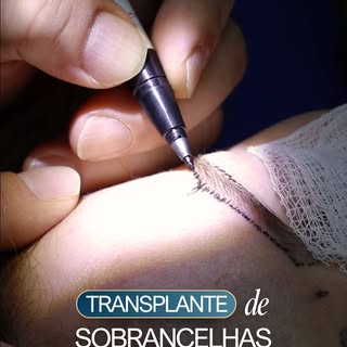Hoje te levamos para dentro da sala de procedimento para acompanhar de perto o transplante de sobran