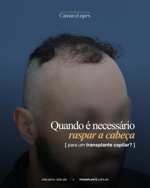 É preciso raspar a cabeça para fazer um transplante capilar?

A resposta depende da avaliação do cas