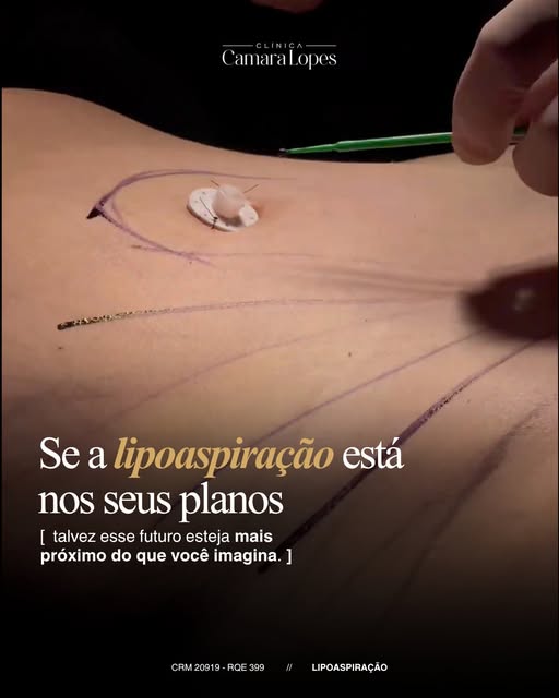 Quando a lipoaspiração deixa de ser apenas uma ideia e passa a ser um plano, o primeiro passo é ente