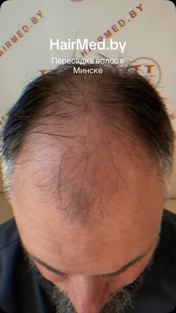 HairMed.by | пересадка волос в Минске. 
Запись на консультацию по телефону +375 44 795-59-42 
Стоимо