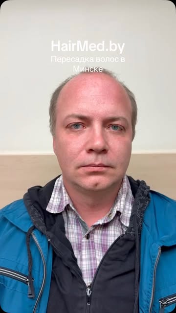 HairMed.by | пересадка волос в Минске. 
Запись на консультацию по телефону +375 44 795-59-42 
Стоимо