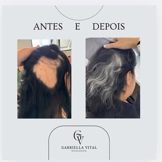 ‼️Reversão completa de uma placa de Alopecia Areata.
Sim, depois de 1 ano e 2 meses de tratamento co