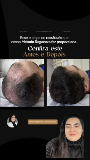 Trouxe um pouquinho do tratamento deste paciente onde precisamos seguir com um tratamento mais longo
