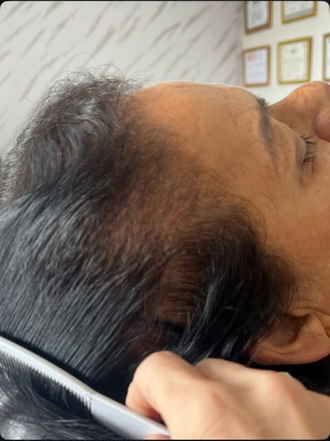 Controlar a queda e estimular nascer cabelo 
Esse foi nosso foco nesse processo 
📍Visite nossa clín