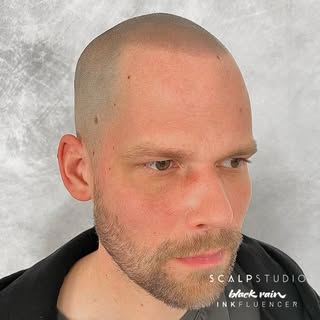 WE BACK WITH THE MOST NATURAL HAIRLINES

using @pygmenta

Client wanted to keep the existing hairlin