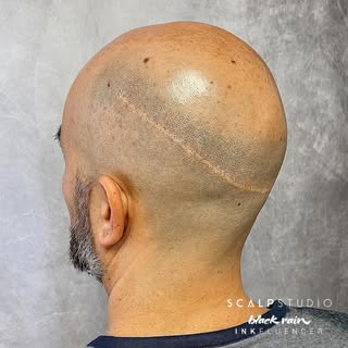 SCAR vs. SMP
Scar camouflage - final result after three sessions. The complete transformation will b
