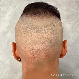 ANOTHER SCAR DESTROYED
SMP is the only solution to cover hair transplant scars - SWIPE to see the ma