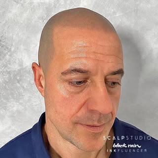 SEE THE POSSIBILITIES

Scalp Micropigmentation is not a treatment like any other. Scalp Micropigment