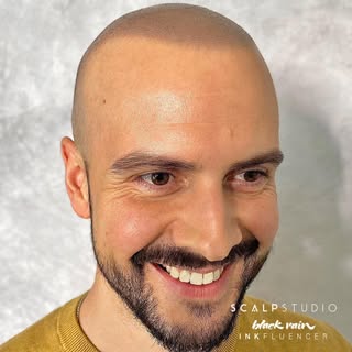 FAILED HAIR TRANSPLANT vs SMP

Get the most realistic results with Scalp Micropigmentation. SMP is a