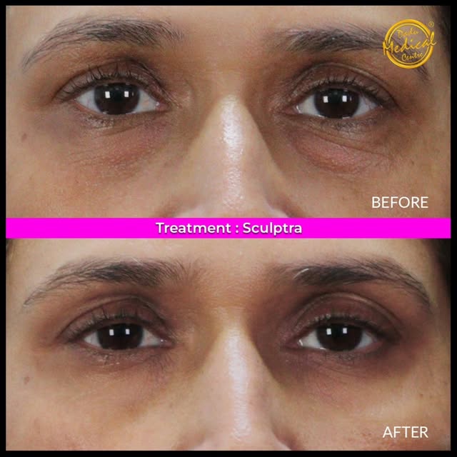 Restore a refreshed, youthful look with long-lasting results! ✨

 Swipe to see the subtle, natural-l