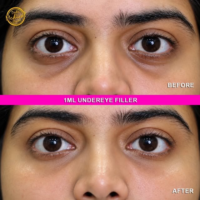 ✨ A subtle change, a refreshed look! ✨

This before-and-after shows the result of 1 mL under-eye fil