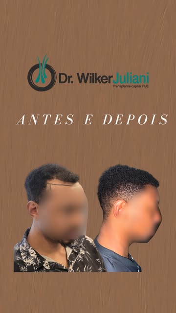 O transplante capilar em cabelo afro exige técnica, precisão e conhecimento profundo da curvatura fo