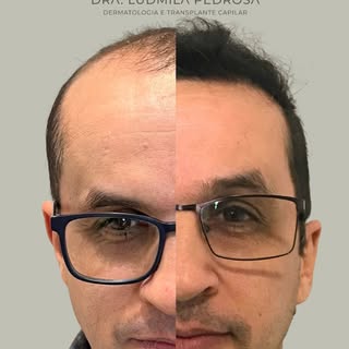 Resultado de antes e depois de transplante capilar. 
Uma transformação construída com técnica, plane