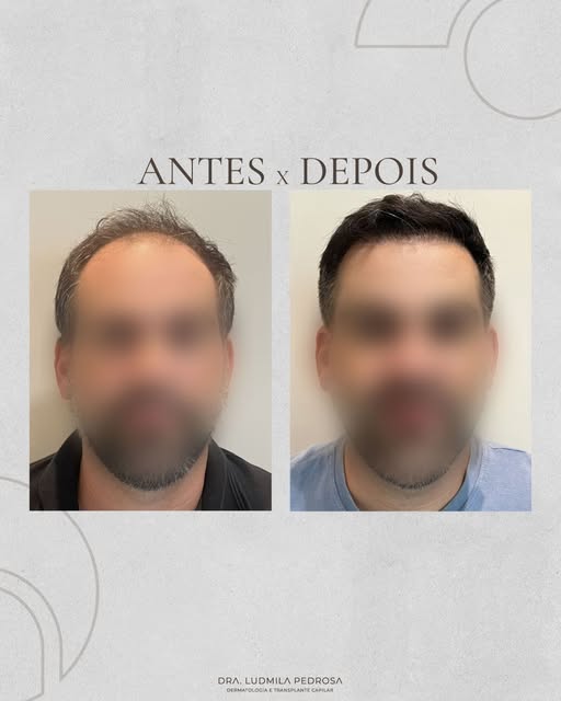 Antes e depois de transplante capilar: resultados que transformam não só os fios, mas também a autoe