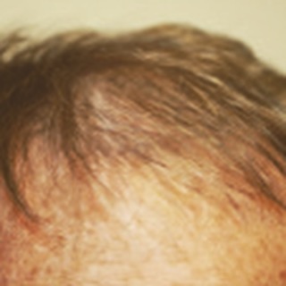 55-year-old patient, John before his #FUE #hairtransplant 1500 grafts