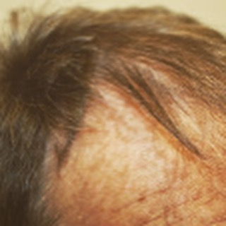 Before his #FUE #hairtransplant @theglasgowclinic 1500 grafts