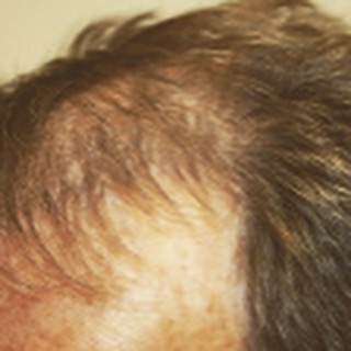 Before our 55-year-old patient John had his #FUE #hairtransplant 1500 grafts