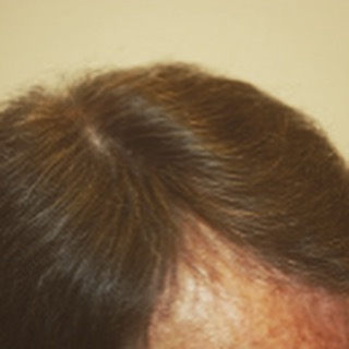 6 months follow-up of our 55-year-old patient 1500 grafts #FUE #hairtransplant