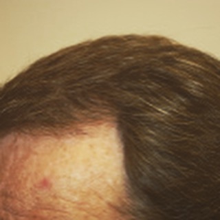 Looking good at 6 months #hairtransplant #FUE 1500 grafts