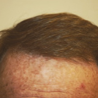 1500 #FUE grafts 6 months following his procedure @theglasgowclinic