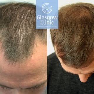 A delighted Andy Webster showing off the results of his recent FUE hair transplant in Glasgow.