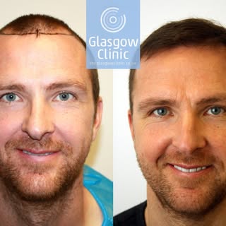 A delighted Andy Webster showing off the results of his recent FUE hair transplant in Glasgow.