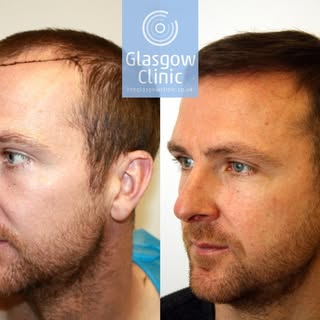 A delighted Andy Webster showing off the results of his recent FUE hair transplant in Glasgow.