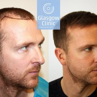 A delighted Andy Webster showing off the results of his recent FUE hair transplant in Glasgow.