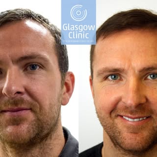 A delighted Andy Webster showing off the results of his recent FUE hair transplant in Glasgow.