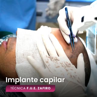 El Implante Capilar en Inception Hair Medical Center es realizado usando la Técnica F.U.E. Zafiro (F