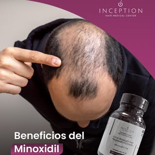 La caída de cabello afecta al 80% de hombres y 40% de mujeres

El minoxidil es uno de los tratamient