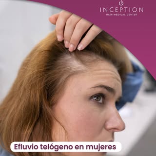 ¿Sabías que el efluvio telógeno crónico es una de las causas más comunes de caída capilar, después d