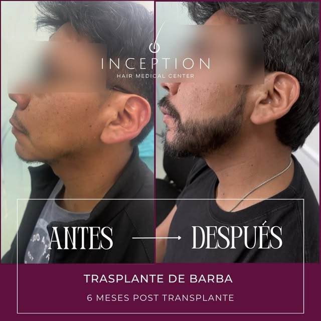 Resultados que hablan por sí solos ✨
Trasplante de barba súper natural con técnica FUE Zafiro, diseñ