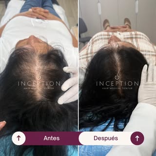 Paciente tratada con nuestra **Mesoterapia Capilar Inception**, un protocolo médico exclusivo diseña