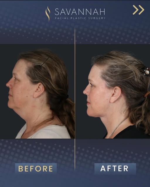 Results by @drtimminton ✨

This sweet patient is 5 months post op from her deep plane facelift, deep
